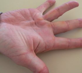 A Different Way to get Annular Tear Treatment